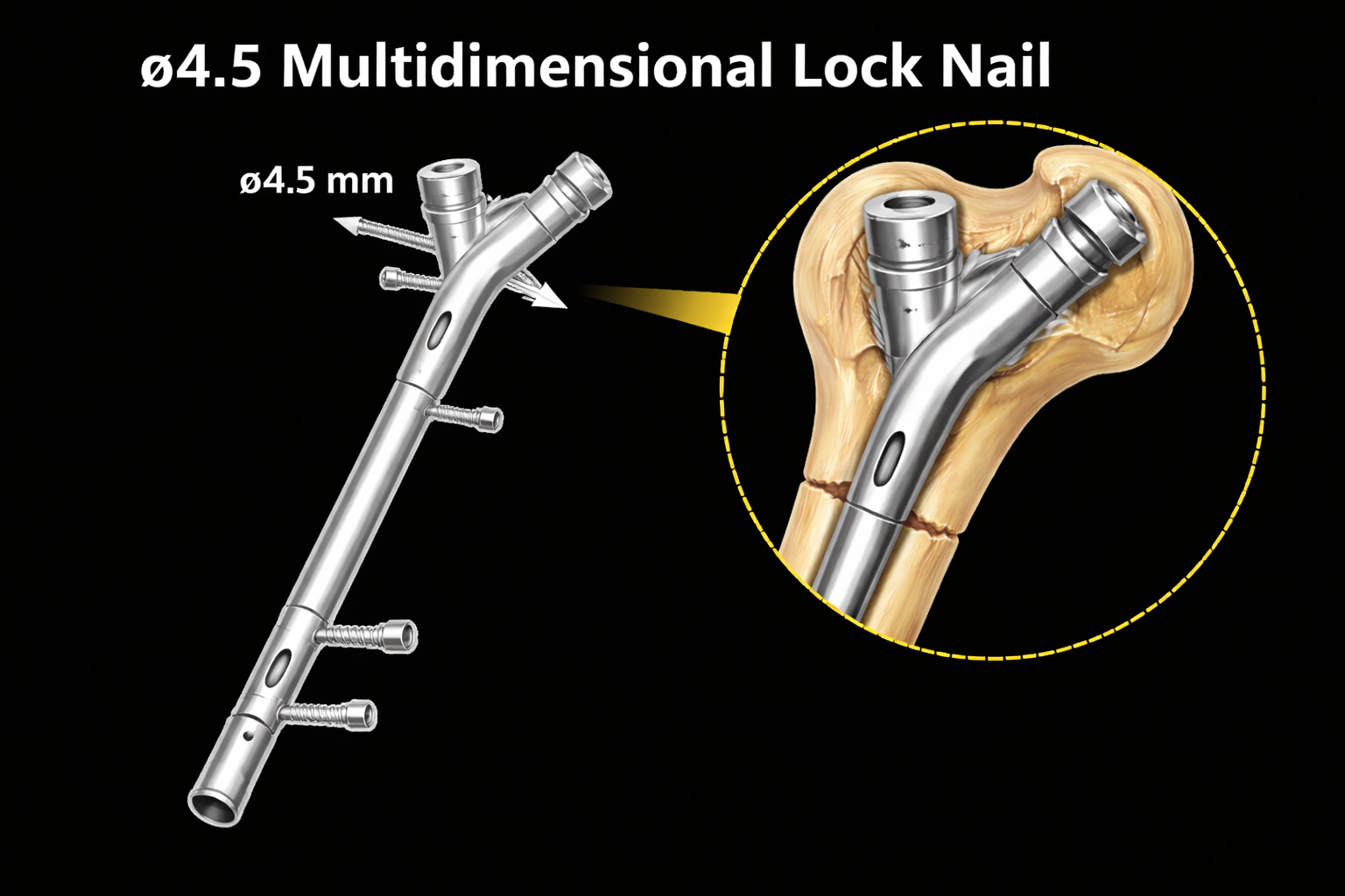 ø4.5 multidimensional lock nail